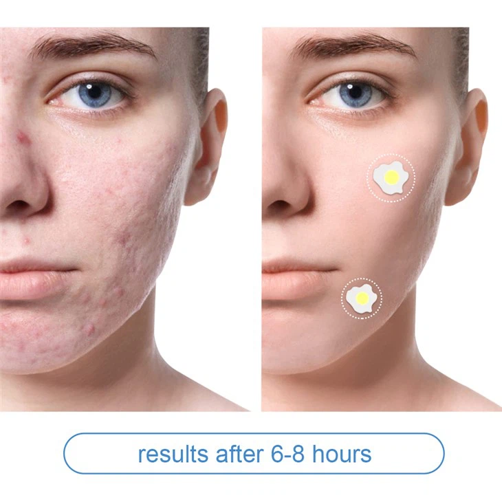 Pimple Patch (16)